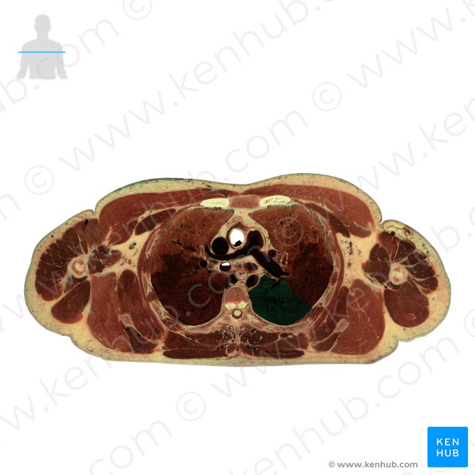 Lobo inferior do pulmão esquerdo (Lobus inferior pulmonis sinistri); Imagem: National Library of Medicine