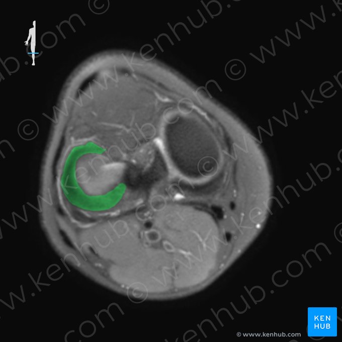 Menisco lateral (Meniscus lateralis); Imagen: 