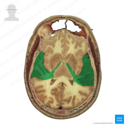 Temporal lobe (Lobus temporalis); Image: National Library of Medicine