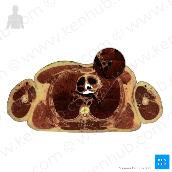 Left pulmonary artery (Arteria pulmonalis sinistra); Image: National Library of Medicine