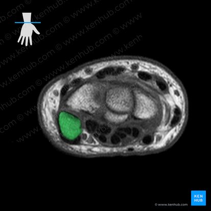 Pisiform bone (Os pisiforme); Image: 