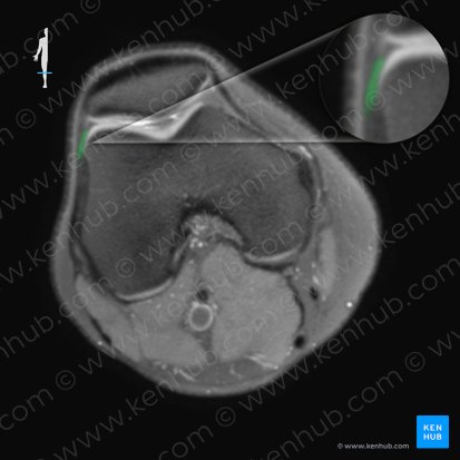 Retináculo patelar lateral (Retinaculum patellae laterale); Imagen: 