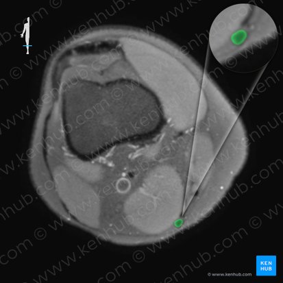 Tendon of semitendinosus muscle (Tendo musculi semitendinosi); Image: 