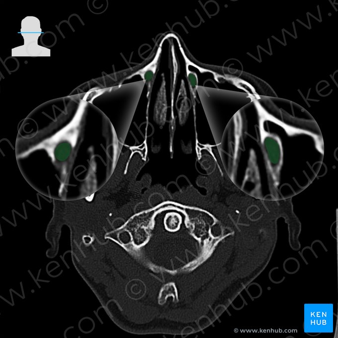 Conducto nasolagrimal (Ductus nasolacrimalis); Imagen: 