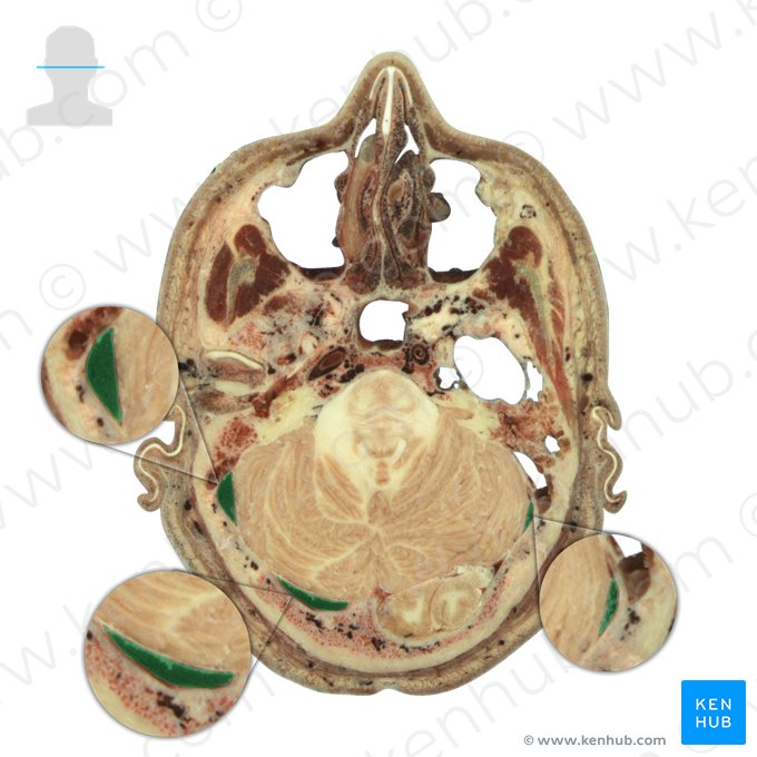 Transverse sinus (Sinus transversus); Image: National Library of Medicine