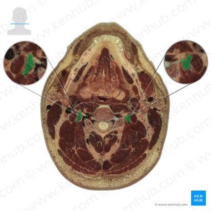 Longissimus cervicis muscle (Musculus longissimus cervicis); Image: National Library of Medicine