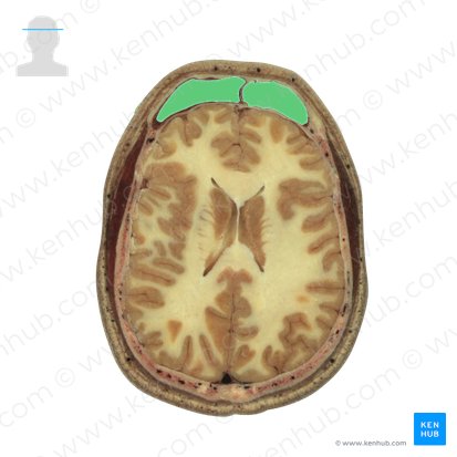 Frontal sinus (Sinus frontalis); Image: National Library of Medicine