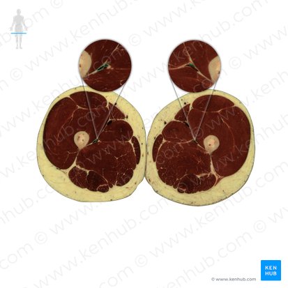 Vena profunda femoris (Tiefe Oberschenkelvene); Bild: National Library of Medicine