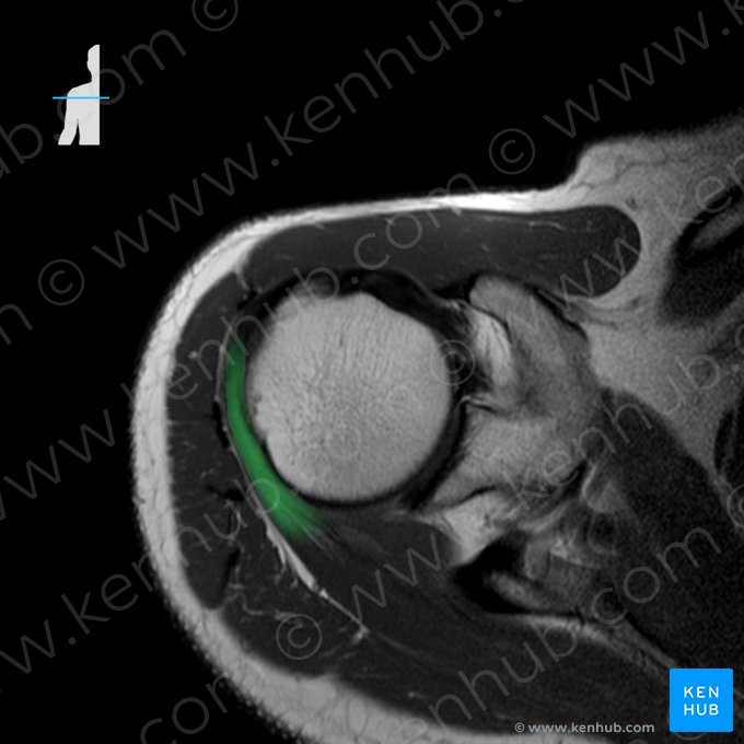 Tendón del músculo infraespinoso (Tendo musculi infraspinati); Imagen: 