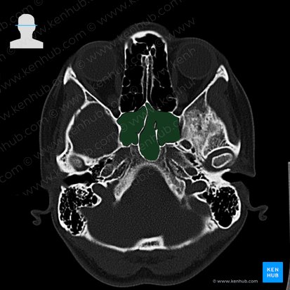 Sphenoidal sinus (Sinus sphenoidalis); Image: 