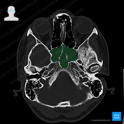 Sphenoidal sinus (Sinus sphenoidalis); Image: 