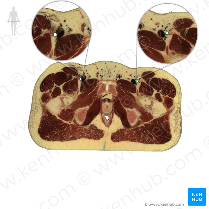 Femoral artery (Arteria femoralis); Image: National Library of Medicine