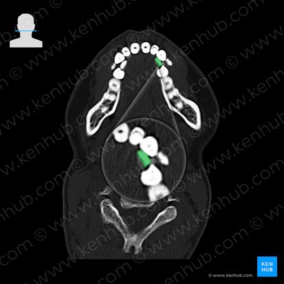 Mandibular left canine tooth (Dens caninus sinister mandibularis); Image: 