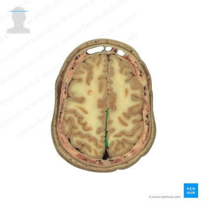 Foice do cérebro (Falx cerebri); Imagem: National Library of Medicine