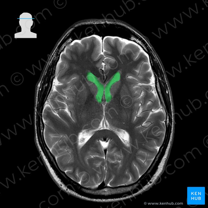 Ventrículo lateral (Ventriculus lateralis); Imagem: 