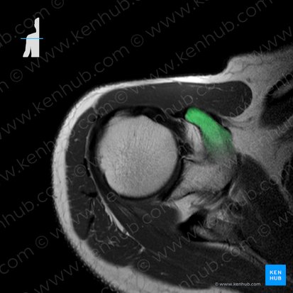 Processus coracoideus scapulae (Rabenschnabelfortsatz des Schulterblatts); Bild: 