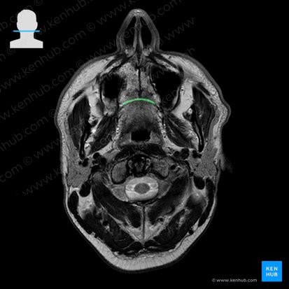 Sutura palatina transversa (Quere Gaumennaht); Bild: 