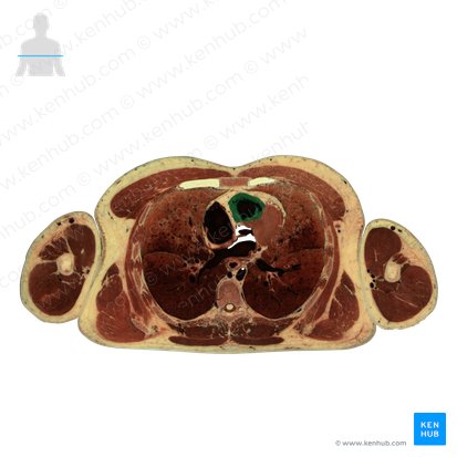 Right ventricle of heart (Ventriculus dexter cordis); Image: National Library of Medicine