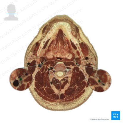 Arteria carótida interna (Arteria carotis interna); Imagen: National Library of Medicine