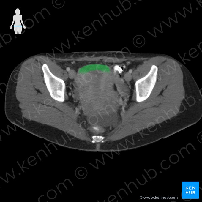 Fundus uteri (Gebärmuttergrund); Bild: 