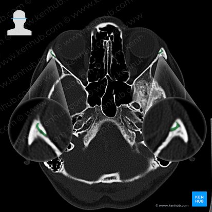 Frontozygomatic suture (Sutura frontozygomatica); Image: 
