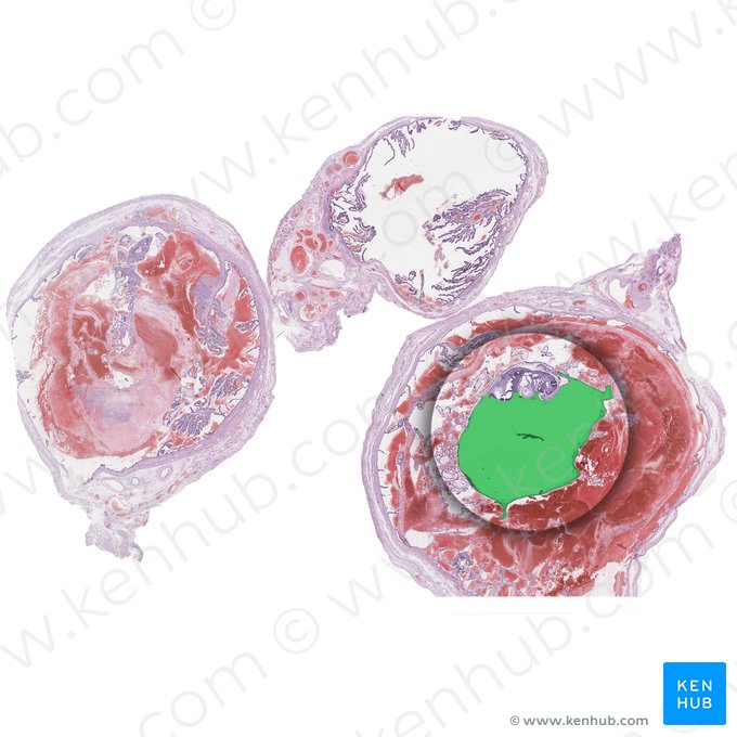 Amniotic sac (Saccus amnii); Image: 