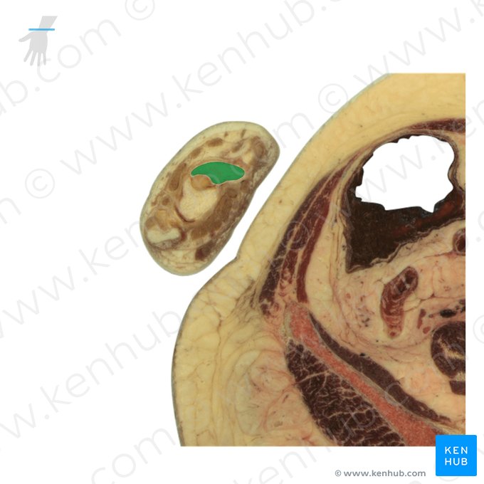 Scaphoid bone (Os scaphoideum); Image: National Library of Medicine