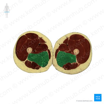 Músculo adutor magno (Musculus adductor magnus); Imagem: National Library of Medicine