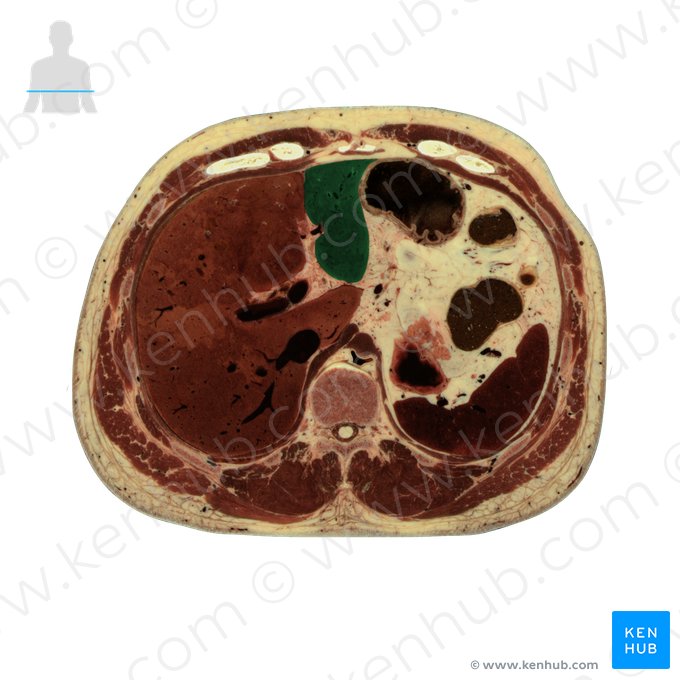 Lobo esquerdo do fígado (Lobus sinister hepatis); Imagem: National Library of Medicine