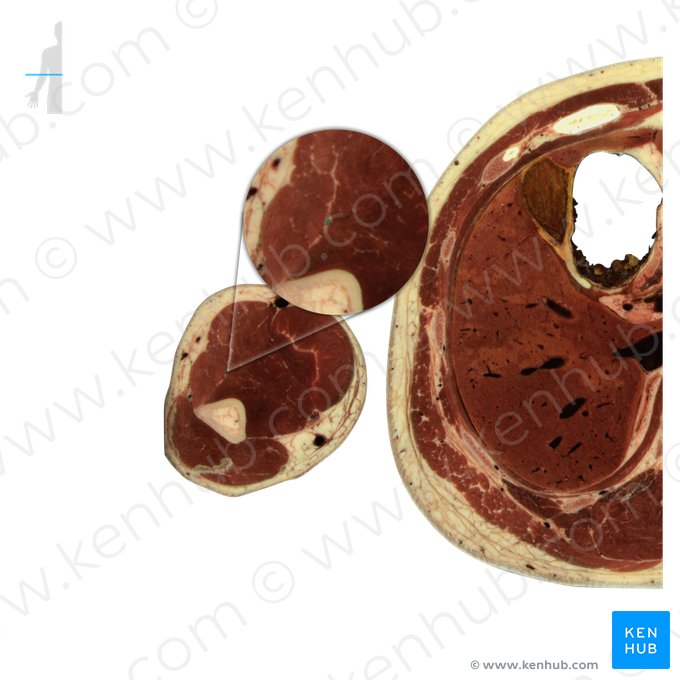 Radial nerve (Nervus radialis); Image: National Library of Medicine