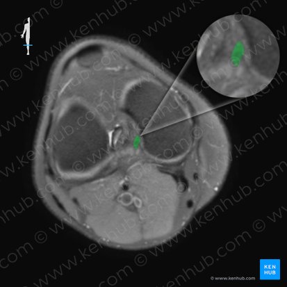 Ligamento cruzado posterior (Ligamentum cruciatum posterius); Imagen: 