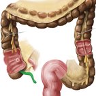 Appendix vermiformis (Wurmfortsatz)