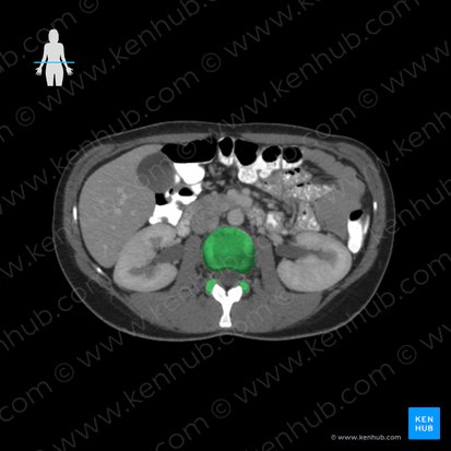 Vértebra L3 (Vertebra L3); Imagen: 