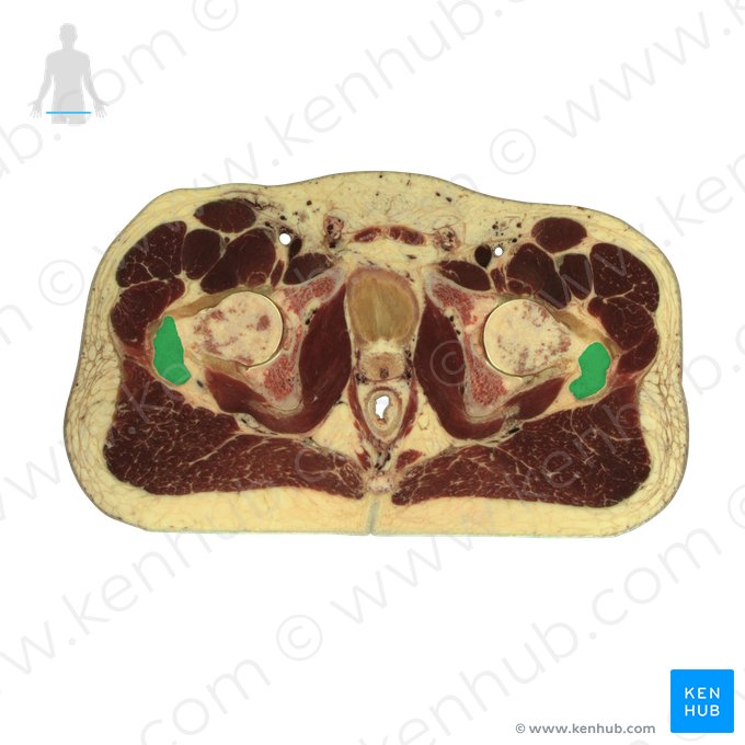 Trochanter major ossis femoris (Großer Rollhügel des Oberschenkelknochens); Bild: National Library of Medicine