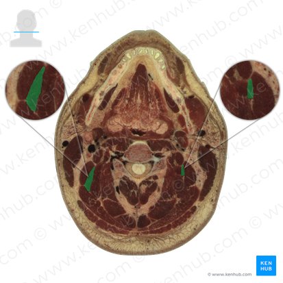 Longissimus capitis muscle (Musculus longissimus capitis); Image: National Library of Medicine