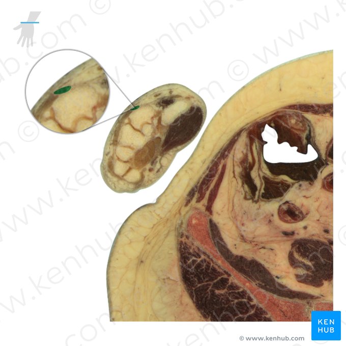 Tendão do músculo extensor radial curto do carpo (Tendo musculi extensor carpi radialis brevis); Imagem: National Library of Medicine