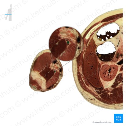 Artéria braquial (Arteria brachialis); Imagem: National Library of Medicine