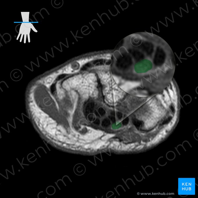 Nervo mediano (Nervus medianus); Imagem: 