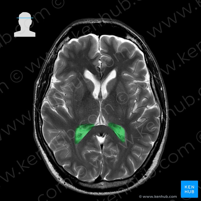 Átrio do ventrículo lateral (Atrium ventriculi lateralis); Imagem: 