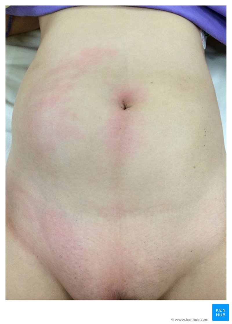 Abdominal wall erythema