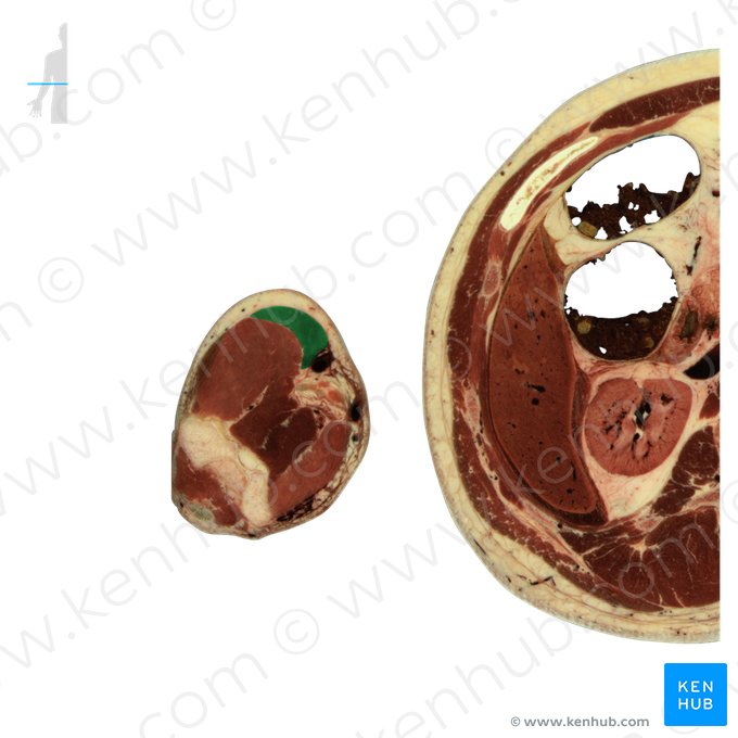 Músculo braquiorradial (Musculus brachioradialis); Imagem: National Library of Medicine