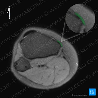 Tibial collateral ligament of knee joint (Ligamentum collaterale tibiale genus); Image: 