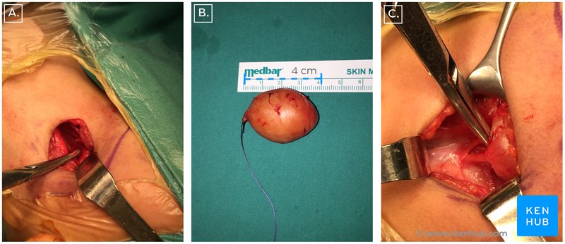 Figure 3: A - neurogenic tumor in situ. B - excised tumor. C - superior part of the sympathetic trunk in situ