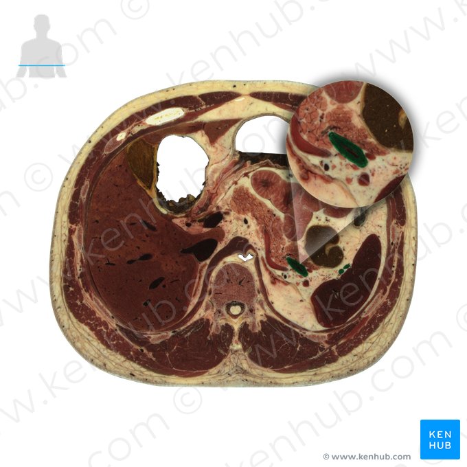 Splenic vein (Vena splenica); Image: National Library of Medicine