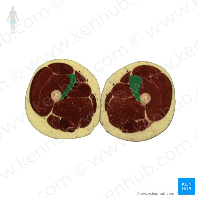 Músculo vasto medial (Musculus vastus medialis); Imagem: National Library of Medicine