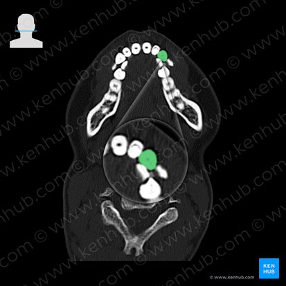 Maxillary left canine tooth (Dens caninus sinister maxillaris); Image: 