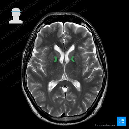 Genu of internal capsule (Genu capsulae internae); Image: 