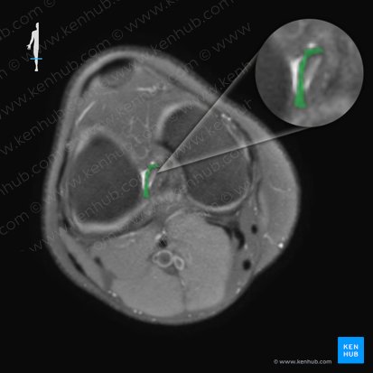 Ligamentum cruciatum anterius (Vorderes Kreuzband); Bild: 