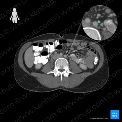 Inferior mesenteric artery (Arteria mesenterica inferior); Image: 