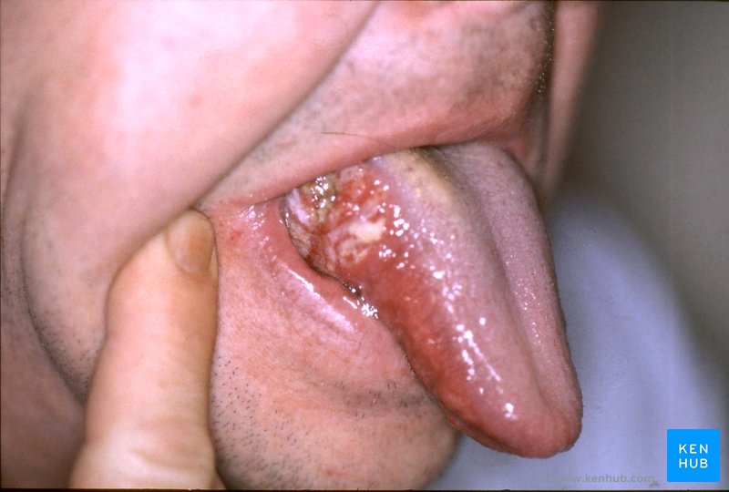 Oral Cancer